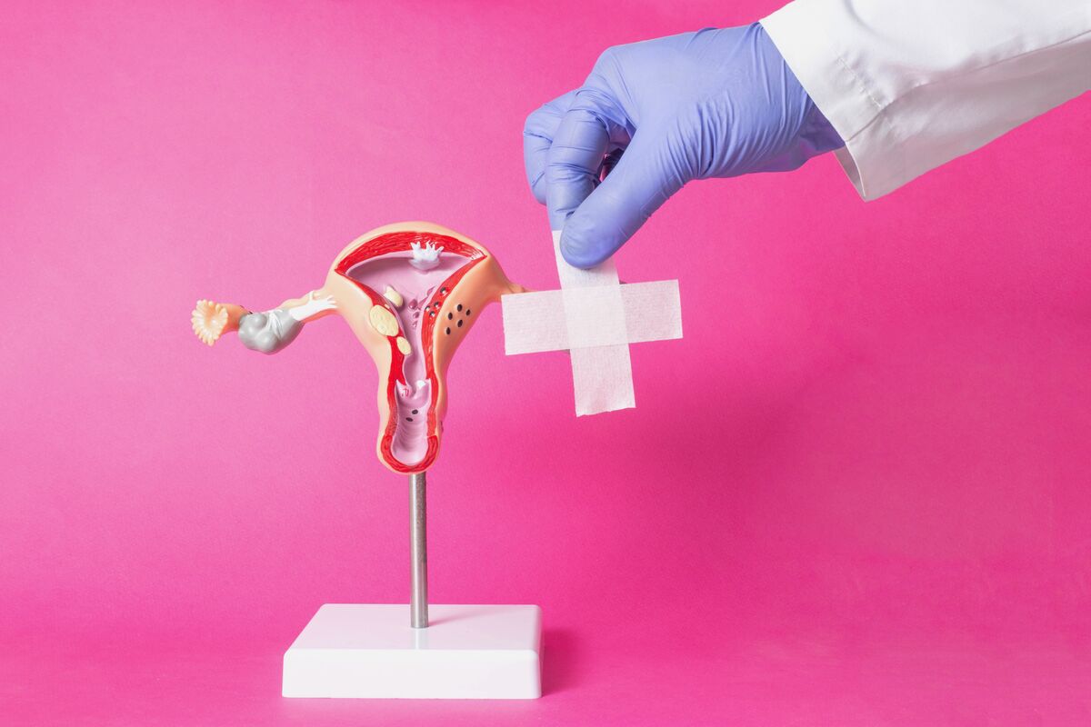 Ring Pessary Fitting and Prolapse Management AM