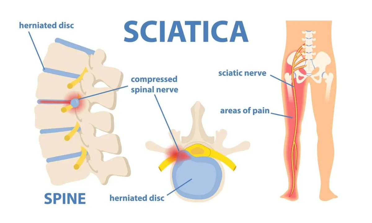 Understanding Sciatica 🕒 (2 CE Hrs – Live Webinar)